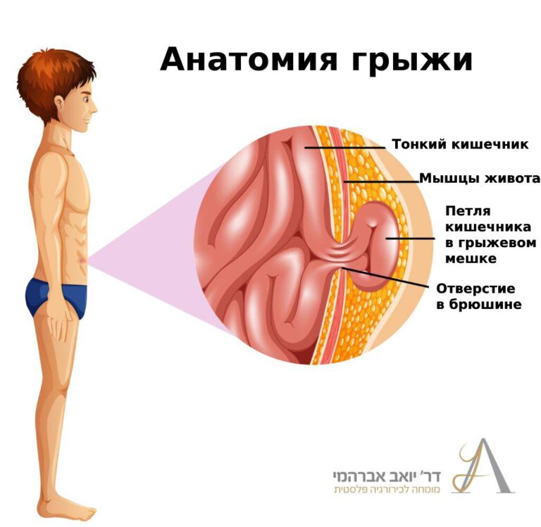 Иллюстрация анатомии грыжи